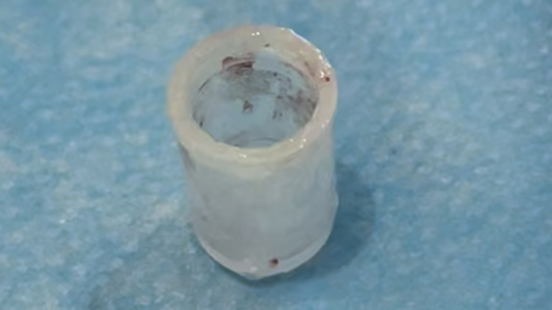 取出的塑料瓶蓋約花生米大小。重慶松山醫院供圖