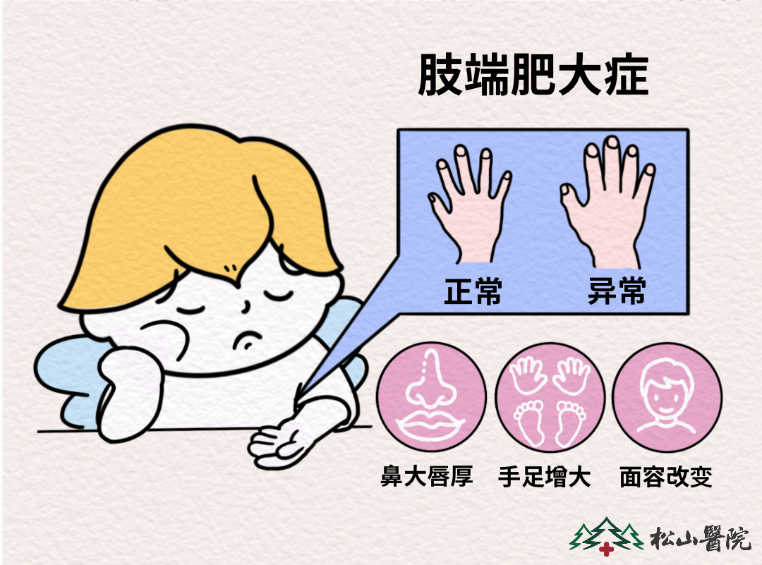 肢端肥大癥癥狀表現。重慶松山醫院供圖