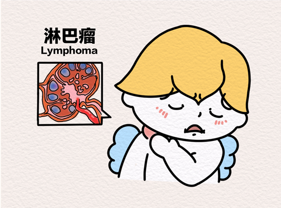 淋巴瘤。重慶松山醫院供圖