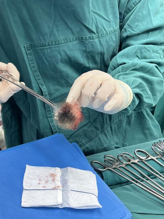 原置換瓣膜周邊已布滿血管翳和血栓。重慶康心醫院供圖