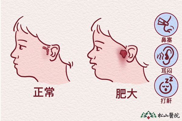 腺樣體肥大。重慶松山醫院供圖