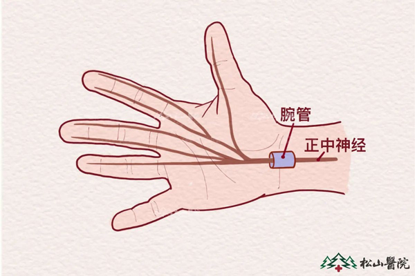 腕管綜合征。重慶松山醫院供圖