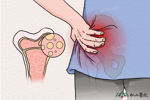 骨髓炎示意圖。重慶松山醫院供圖