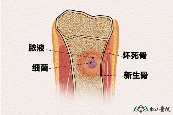 骨髓炎示意圖。重慶松山醫院供圖