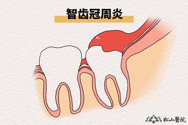 智齒冠周炎。重慶松山醫院供圖