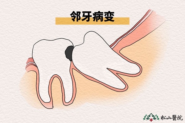 鄰牙病變。重慶松山醫院供圖