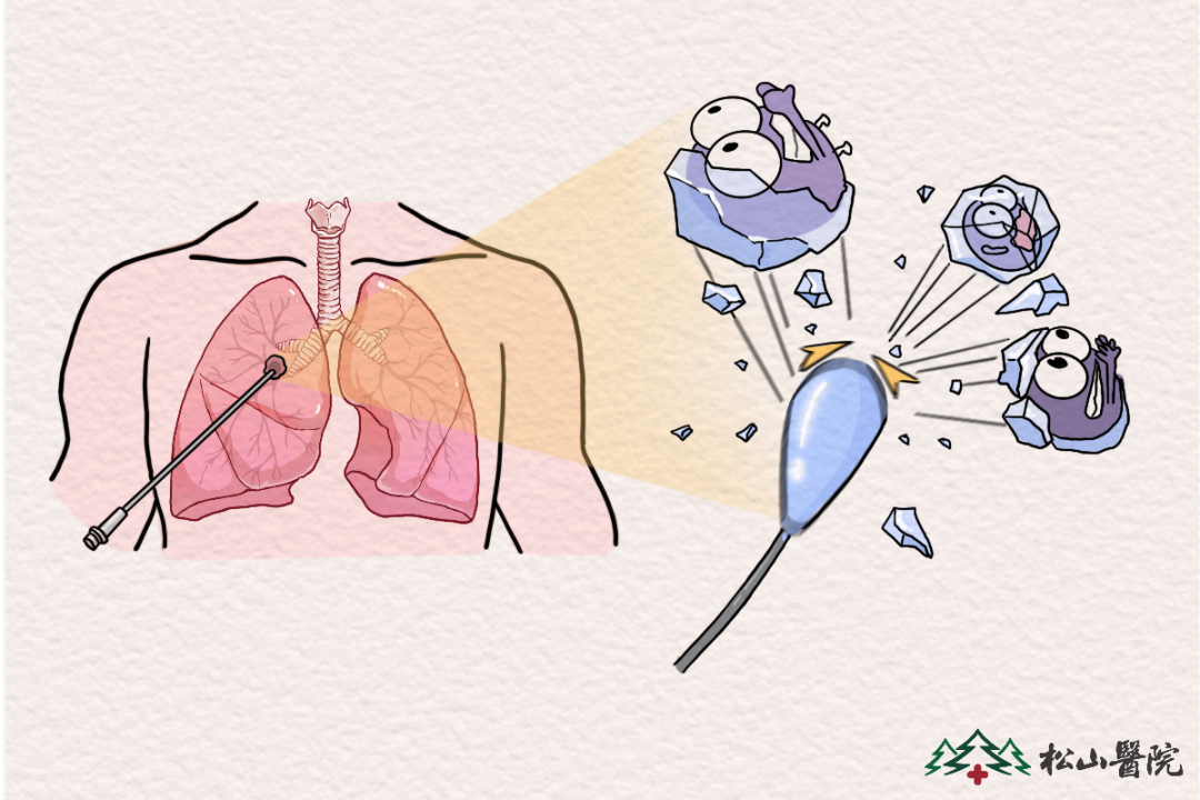 冷凍消融。重慶松山醫院供圖