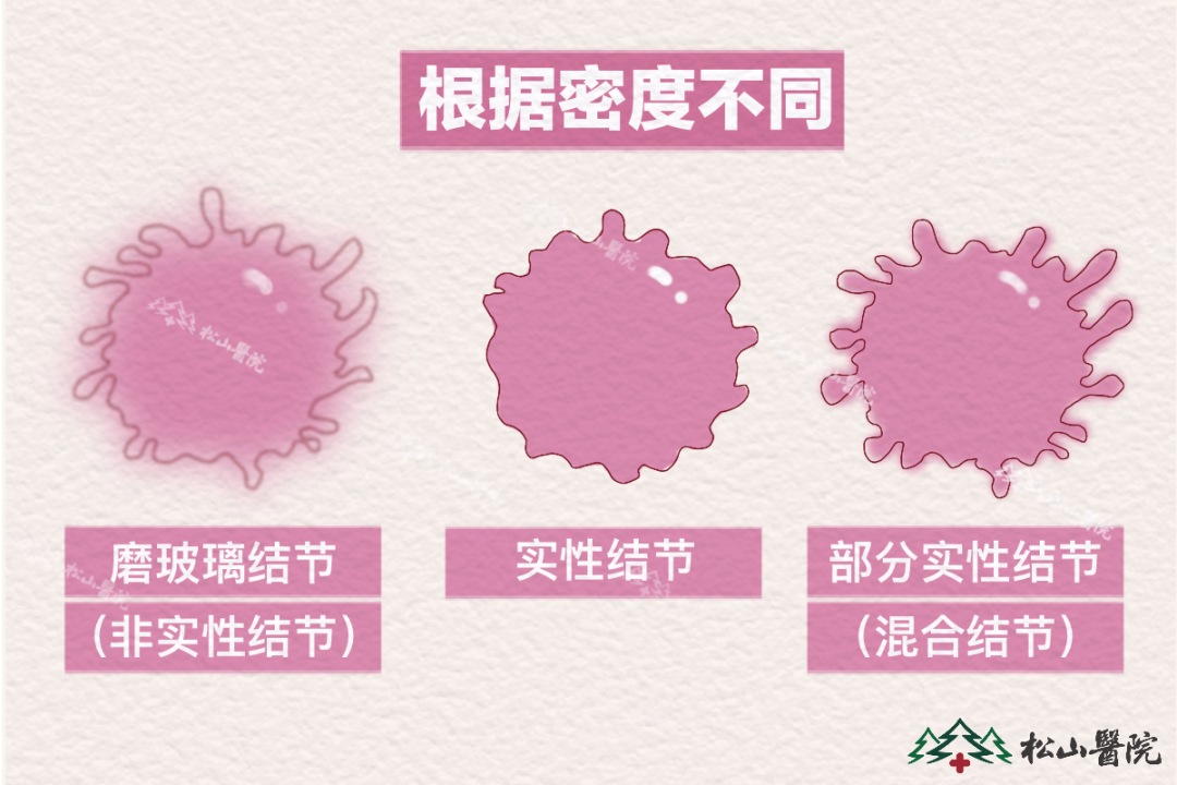 肺結節。重慶松山醫院供圖