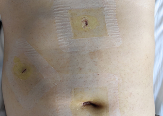 傷口情況。重慶手術醫院供圖