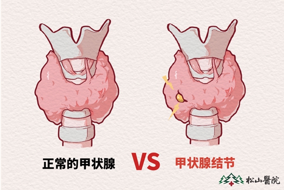甲狀腺。重慶松山醫院供圖