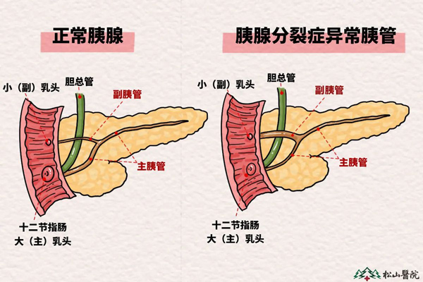胰腺分裂癥示意圖。重慶松山醫院供圖