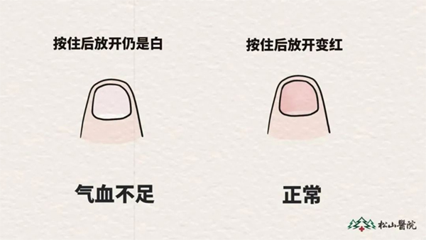 氣血不足與氣血充足時指甲對比。重慶松山醫院供圖