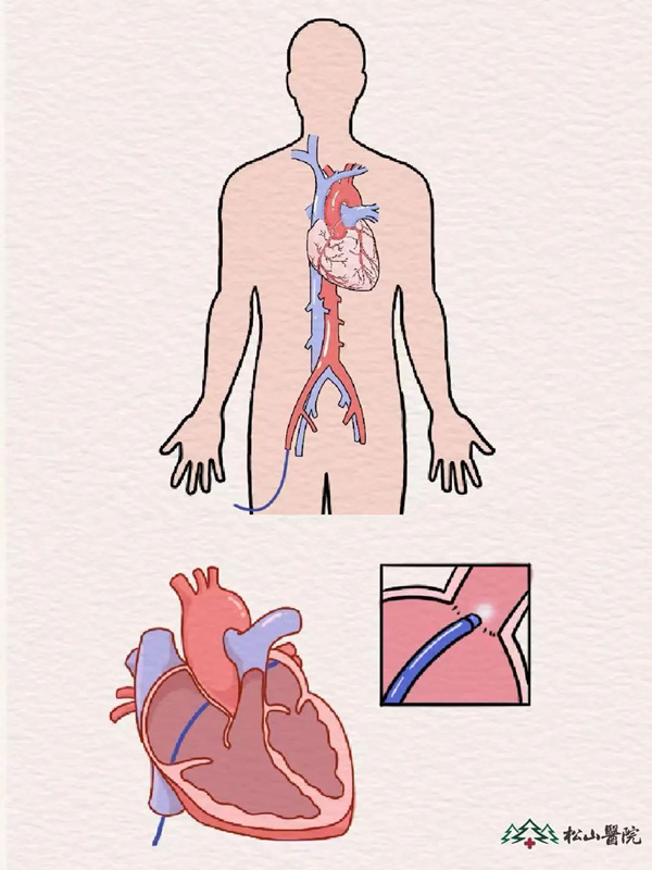 示意圖。重慶松山醫院供圖