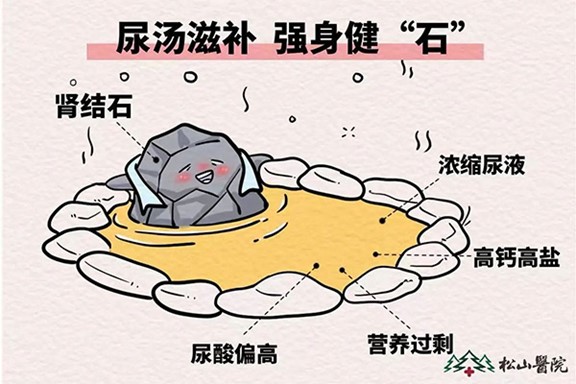 腎結石。重慶松山醫院供圖