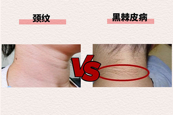 頸紋和黑棘皮病的區別。重慶松山醫院供圖