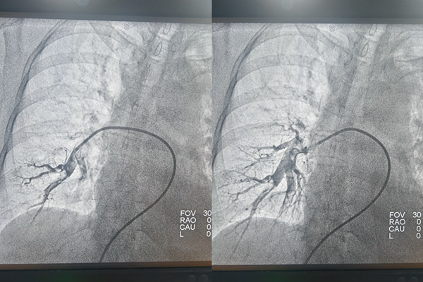 手術前后肺動脈造影對比。重慶兩江新區人民醫院供圖