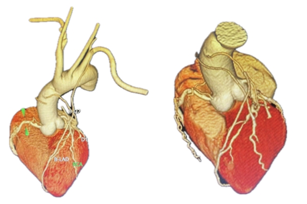 向先生冠脈造影三維重建圖。重慶醫科大學附屬第二醫院供圖