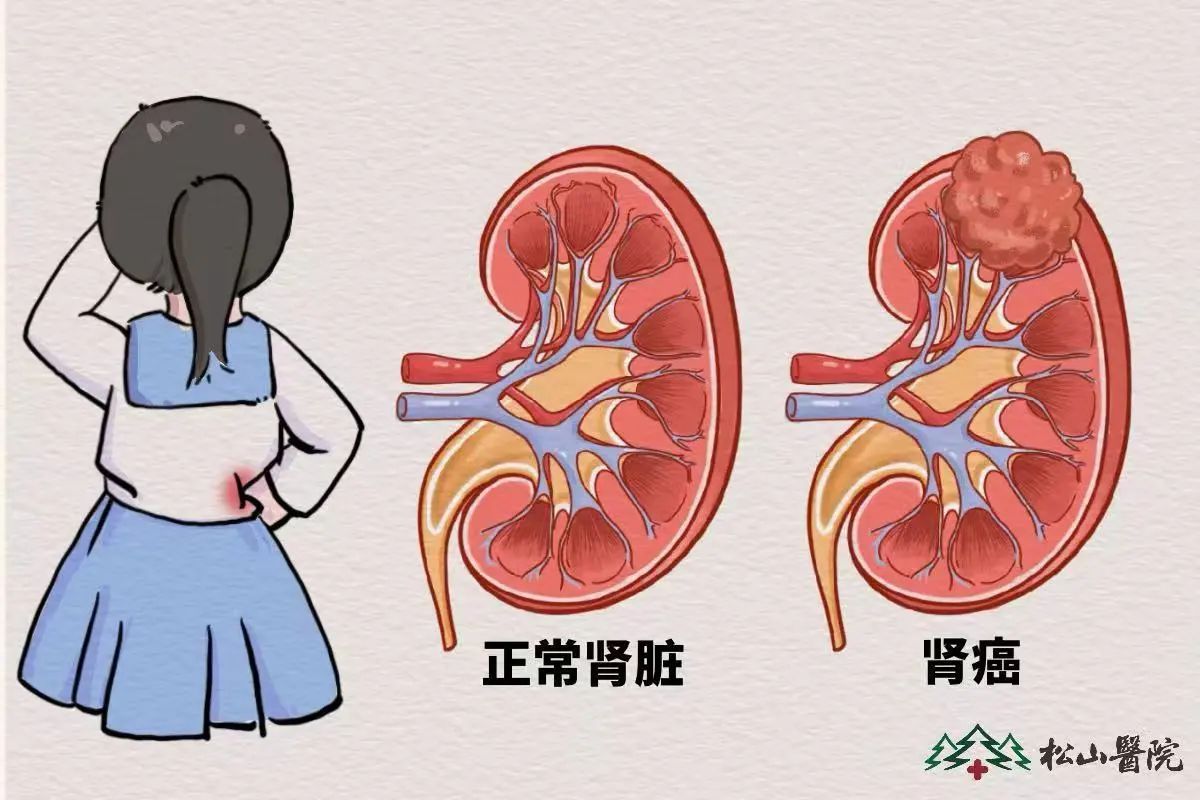 腎臟。重慶松山醫院供圖