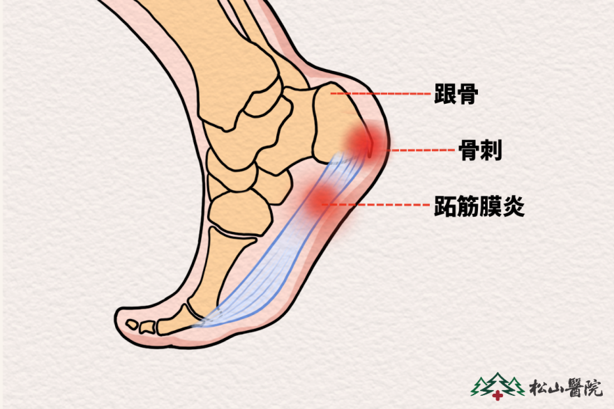 跖筋膜炎、跟骨骨刺。重慶松山醫院供圖