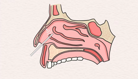 示意圖。重慶松山醫院供圖
