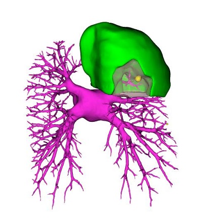 通過三維重建技術鎖定病灶（黃色圓圈）。重醫附屬大學城醫院供圖
