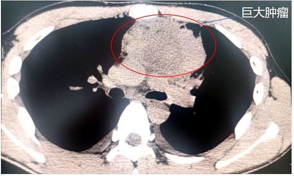 前上縱隔頸胸交界處巨大腫瘤。重醫附屬大學城醫院供圖