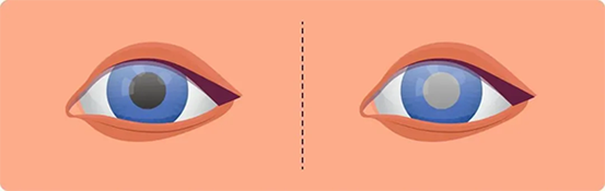 白內障。重慶南坪愛爾眼科醫院供圖