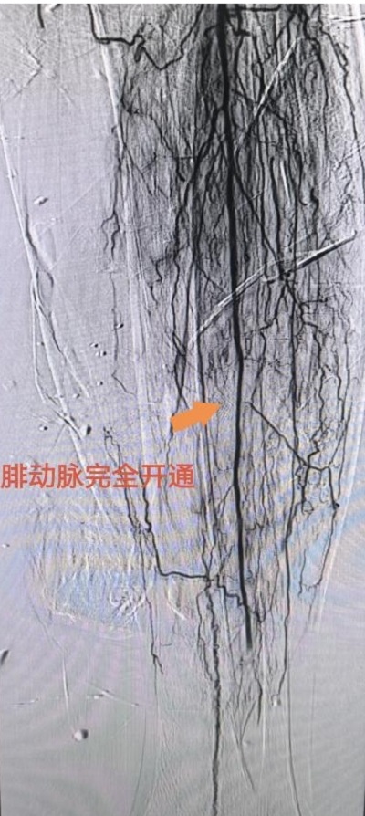 術后，患者左腿部腓動脈血管完全開通。重醫附屬大學城醫院供圖