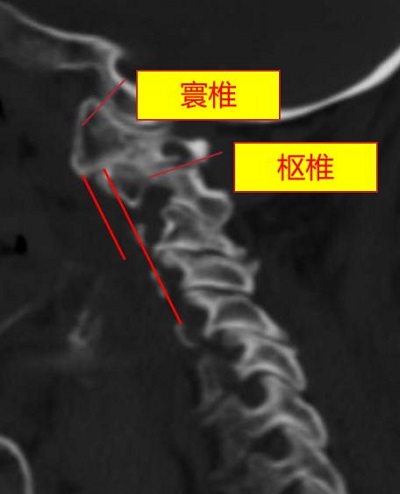 術前，頸椎CT顯示寰樞椎脫位（正常為寰椎、樞椎在同一水平線）。重慶市人民醫院（重慶大學附屬人民醫院）供圖