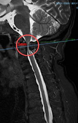 術前，頸椎MRI顯示，患者脊髓嚴重受壓（圓圈處）。重慶市人民醫院（重慶大學附屬人民醫院）供圖
